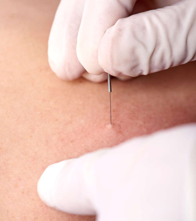 Dry Needling